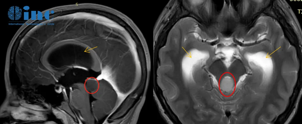 2018年2月头颅核磁检查：脑干-中脑顶盖占位伴梗阻性脑积水