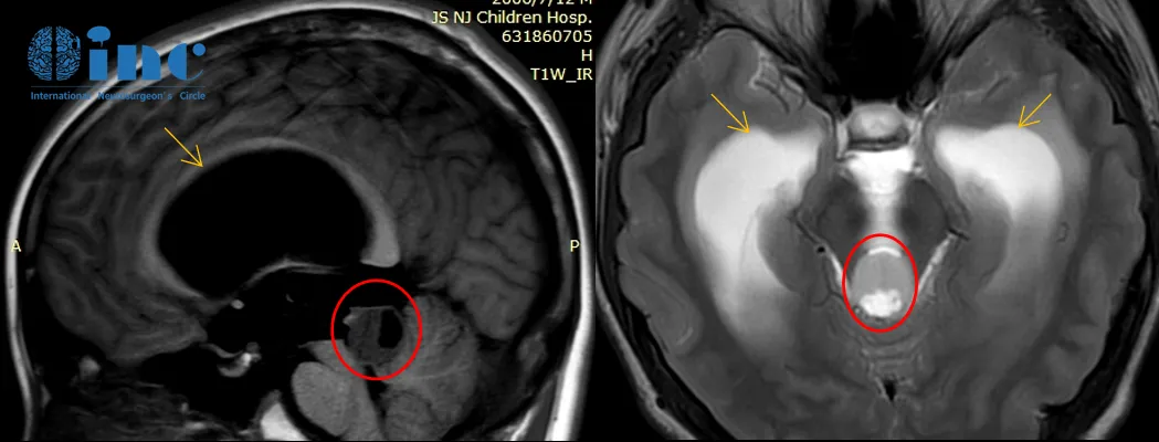 2020年8月头颅核磁检查：肿瘤较前增大，脑积水较前明显加重