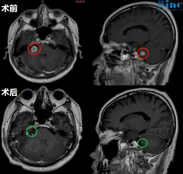 INC巴教授切除听神经瘤，  　　成功保面、保听