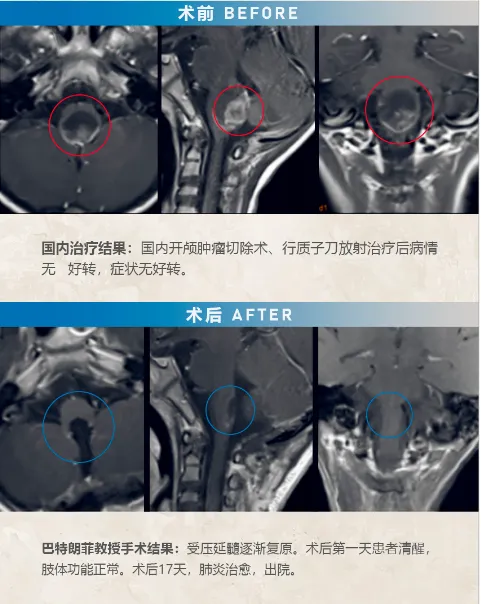 室管膜瘤复发，  　　INC巴教授二次手术全切