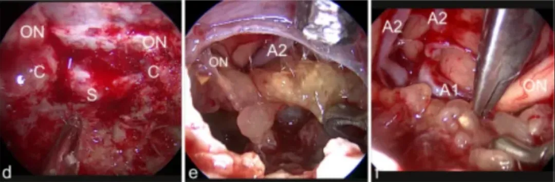 d图中，经鼻内镜手术入路暴露。视神经的隆起（ON）可以看到总颈动脉（C）和鞍状硬脑膜（S）。e图表示切除之后肿瘤隆起，肿瘤上表面暴露在30°内窥镜下观察。右前A2节段可见脑动脉和右视神经（ON）。f图中，从视交叉切开肿瘤，使用镊子双向牵拉分离暴露（视神经ON）、A1和前脑动脉的A2段（A1，A2）。