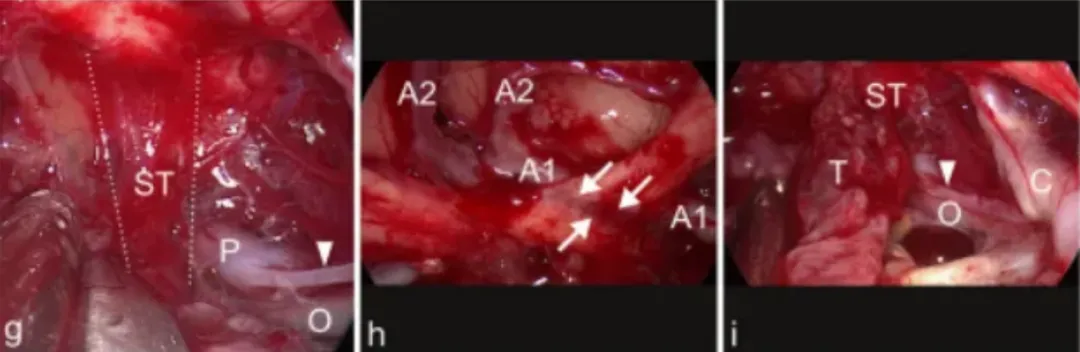g图表示背侧肿瘤表面，垂体柄浸润（ST，在虚线）被可视化处理眼动脉（O），后交通动脉P1段（P）和后交通动脉（箭头）。h图表示肿瘤切除后，左视神经内出现严重的压迹（箭头），由于肿瘤对神经的压迫和A1区段引起的可以看到大脑前动脉（A1和A2）。i图中，最终检查显示垂体后叶浸润（ST）后部、交通动脉（箭头）、岩上段颈内动脉（C）和动眼神经（O）的肿瘤残留（T）