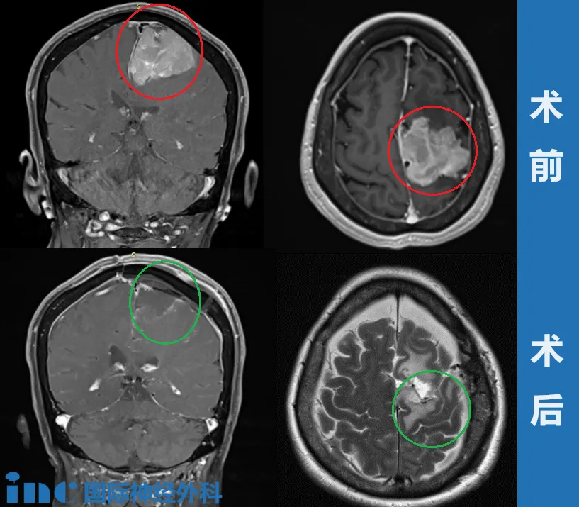大脑镰旁巨大脑膜瘤，INC巴教授如何顺利全切