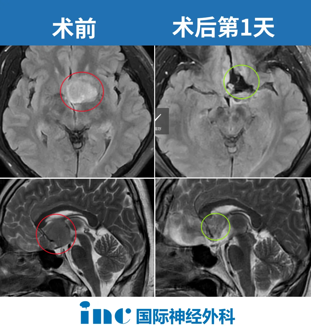 陆先生术后影像