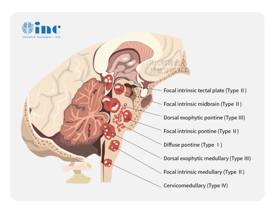 脑干肿瘤分类，可以来自中脑、脑桥、延髓及高位颈髓部位，根据肿瘤生长特点可以分为局灶型、外生型、弥漫型，不同型治疗或预后会有差别。