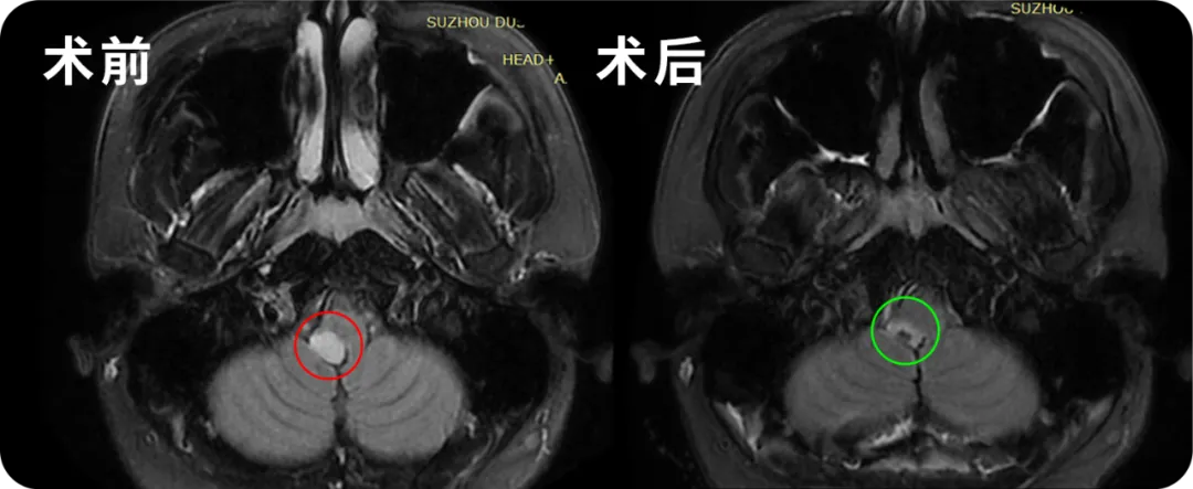 术后情况：