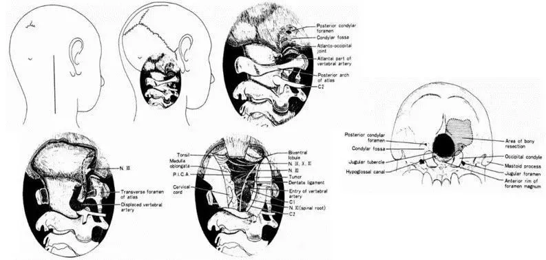 Bertalanffy和导师Seeger（1991）提出的“dorsolateral,suboccipital,transcondylar approach”入路，为现代远外侧入路的完善和发展奠定基石。