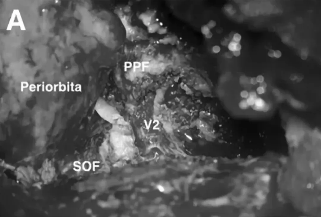 SOF、PPF和V2暴露，注意保护神经血管，识别和定位肿瘤。