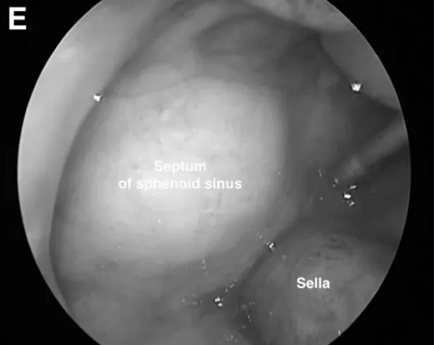 SphS蝶窦的内镜视图。使用颞肌封闭蝶窦SphS，并用明胶海绵和纤维蛋白胶封闭。