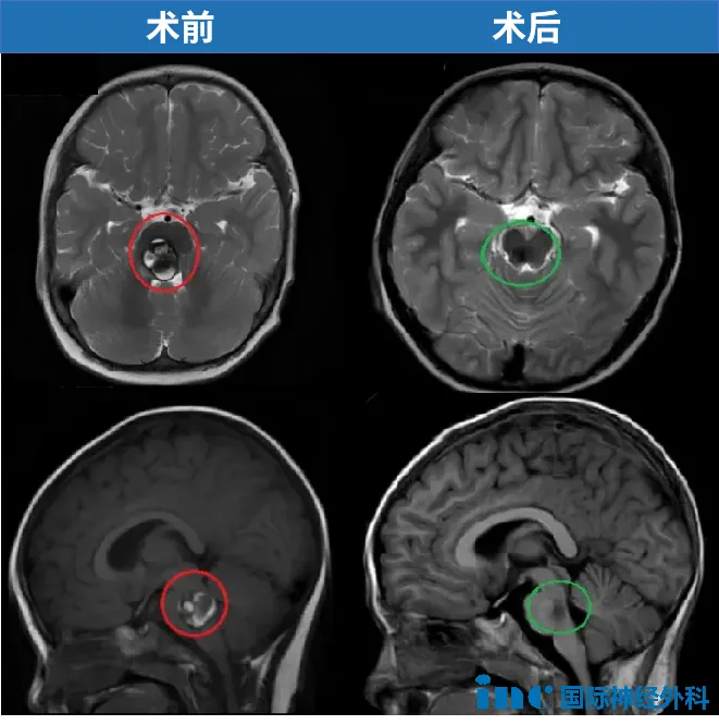 2岁，聪聪，脑干-脑桥海绵状血管瘤