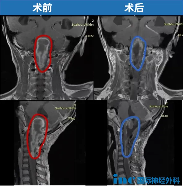 6岁，琦琦，脑干延髓，一直延伸至颈5节段脊髓