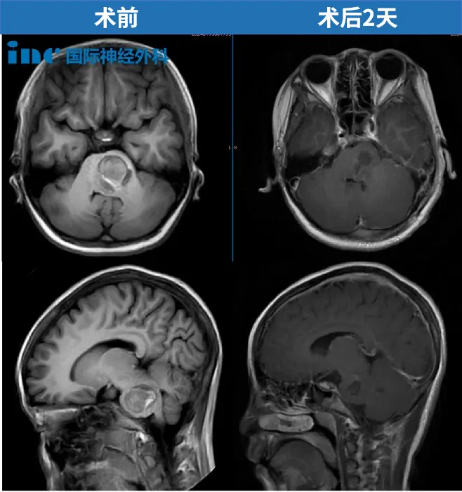 11岁，贝贝，脑干海绵状血管瘤出血