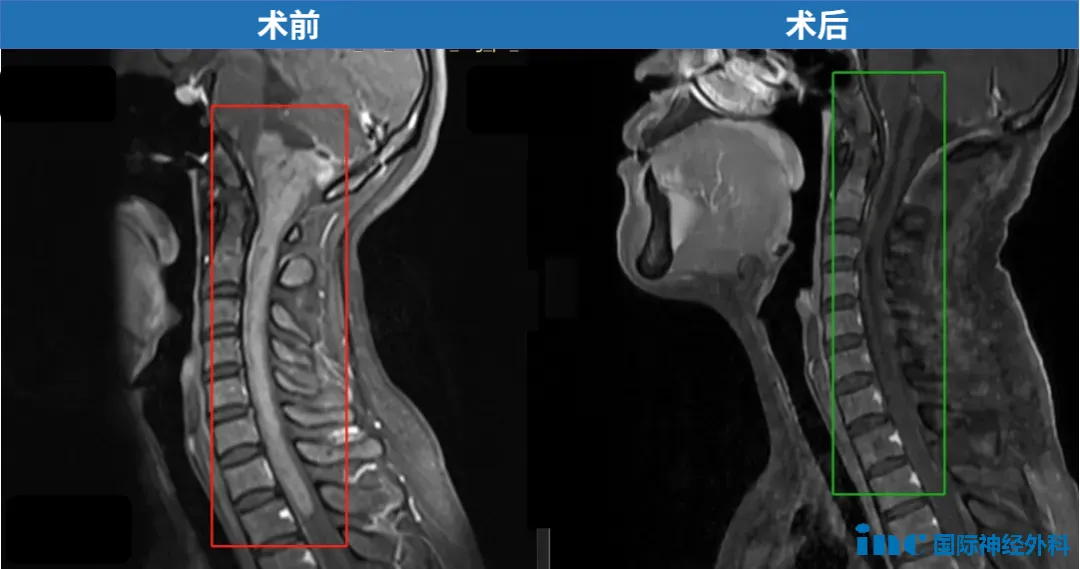 33岁，郑女士，15cm肿瘤起源于脑干下部，累及延髓和颅颈交界区