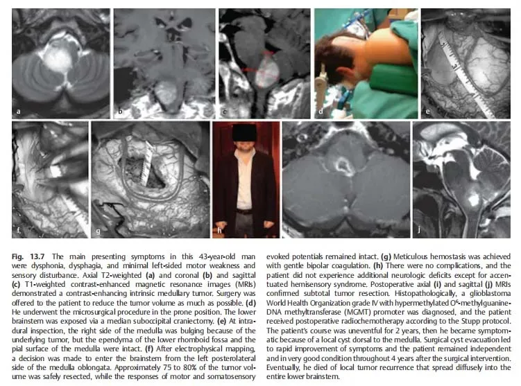 2020年新版的世界脑干手术专著《Surgery of the Brainstem》