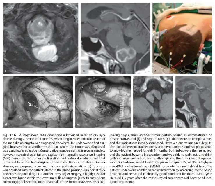 延髓胶质瘤手术案例