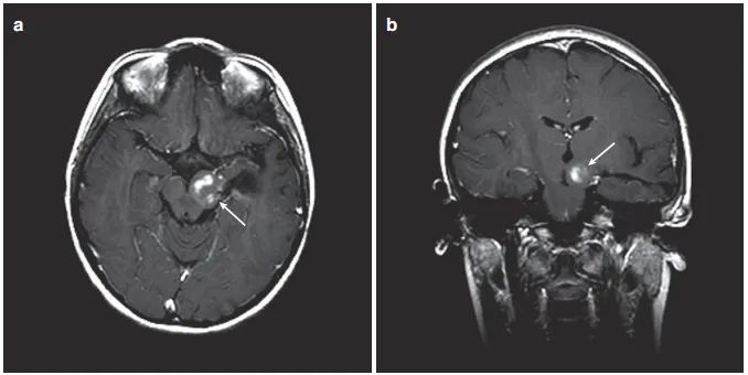 图3：患儿术后MRI，(a)轴位增强MRI显示肿瘤少量残留在左侧被盖