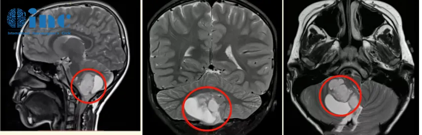 7岁男孩小脑-脑干胶质瘤