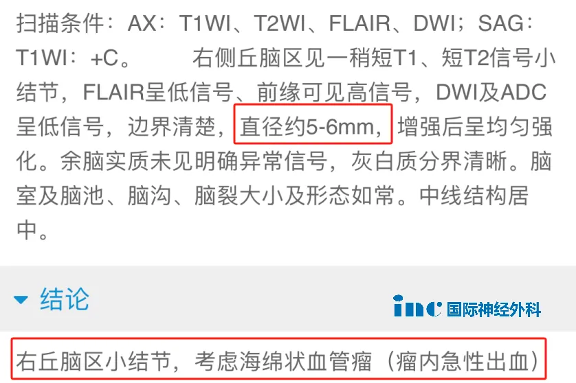 核磁共振成像，仅显示右侧丘脑后部一个很小的病灶，尚未影响到中脑。