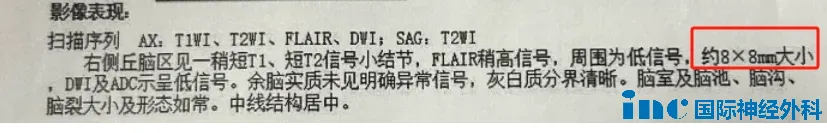 剖腹产后2个月核磁共振成像，显示病灶有所增大，但尚未出血。病灶在丘脑，未影响到中脑。