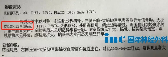 核磁共振成像图显示严重的出血，占位性血肿从右侧丘脑后部向下延伸至中脑，明显影响到中脑。