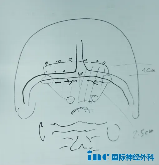 巴教授手绘手术切口