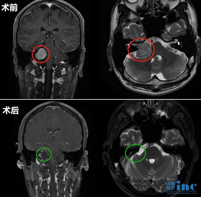 肿瘤尺寸巨大，巴教授顺利全切