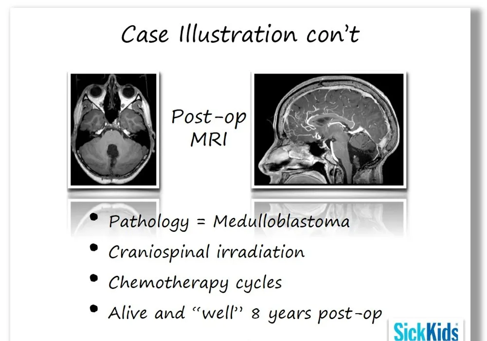 Rutka教授案例分享：髓母细胞瘤联合治疗，良好生存长达8年