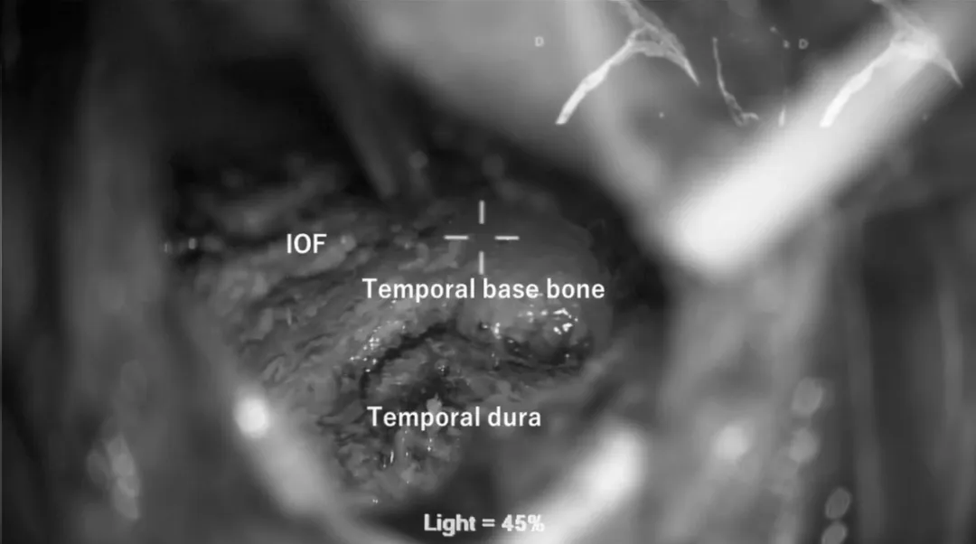 进行眶下壁（IOF）与颞骨之间的解剖分离，并分离颞部的硬脑膜，从而切除肿瘤。