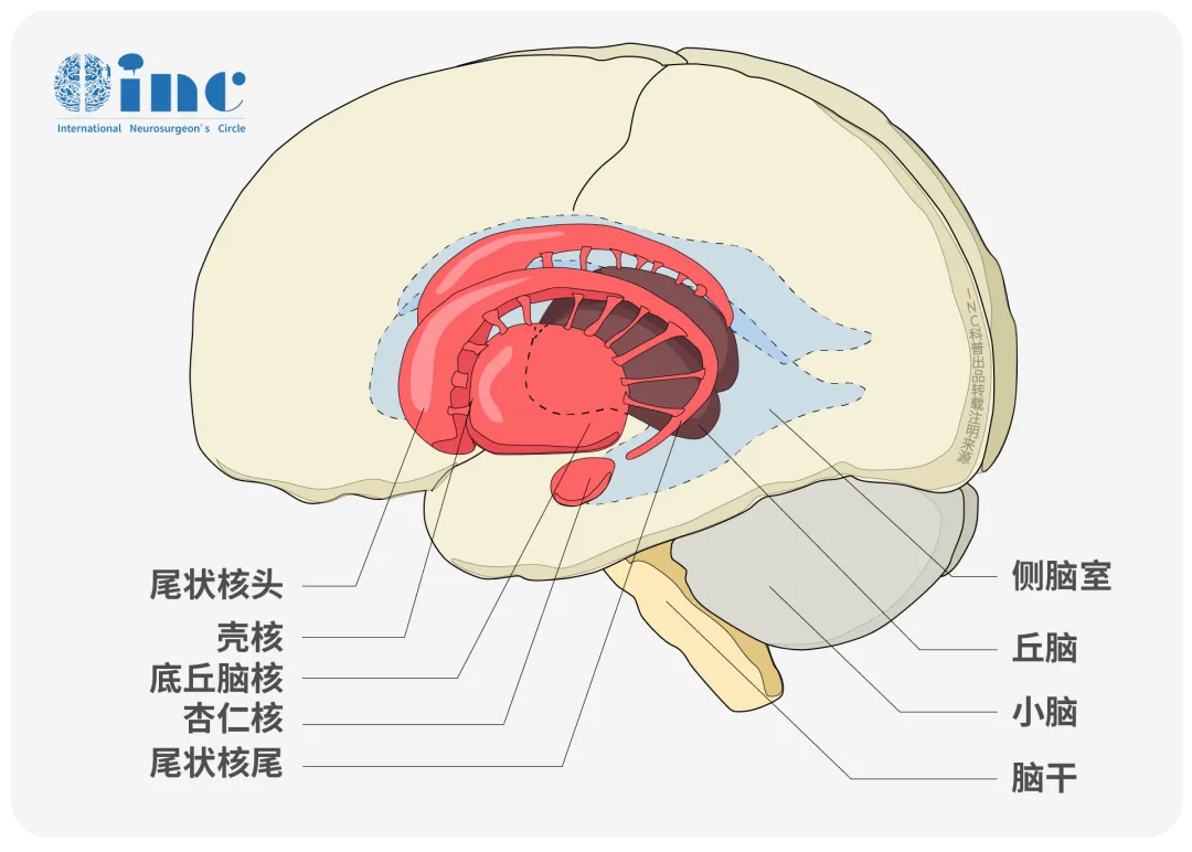 18岁少年AVM术后竟再出血…INC脑血管专家Lawton教授如何全切“颅内炸弹”？