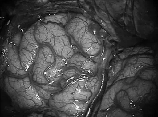 左侧翼点开颅，再次手术，显露前颞叶