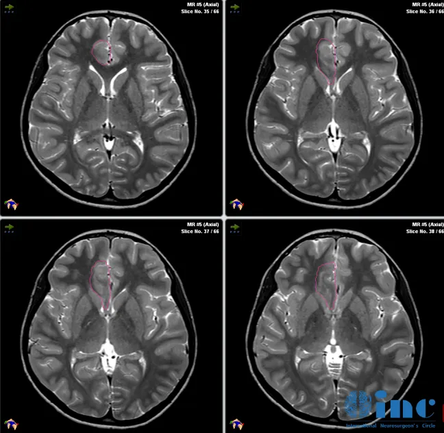 在MRI引导技术，教授团队清晰地识别病灶与周围健康脑组织的位置关系，进而制定精确的手术路径，成功消融了Jason脑内残余的病变组织。