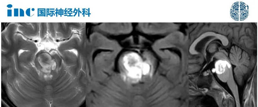 这个位置的脑出血竟会瘫痪、失语，但是却有治愈机会！