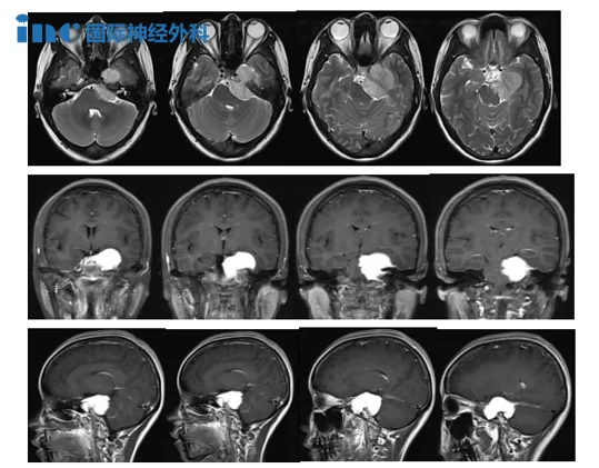 左侧岩尖区团块状占位，考虑脑膜瘤