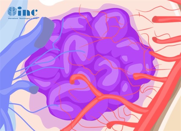 脑血管瘤为什么会半身瘫痪